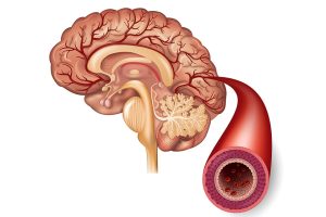 Normal brain and artery